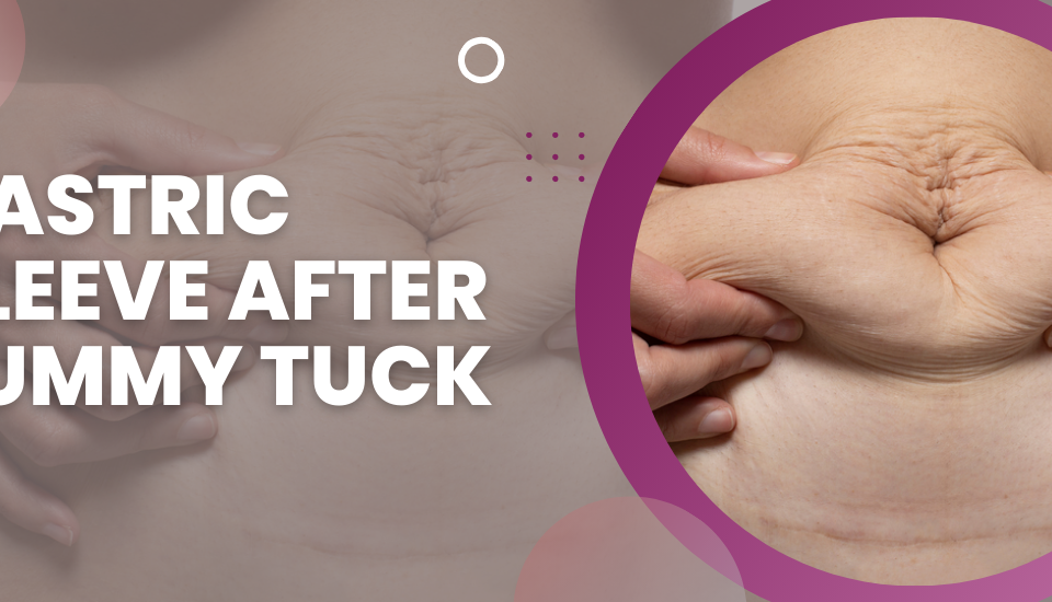 Gastric Sleeve After Tummy Tuck