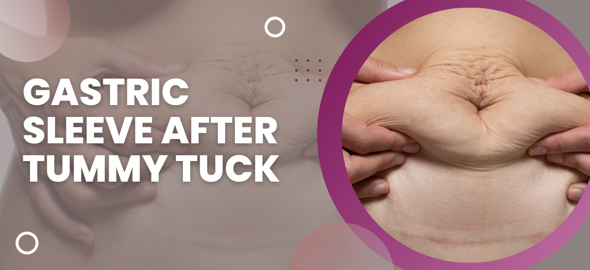 Gastric Sleeve After Tummy Tuck