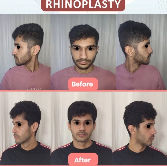 rhinoplasty results