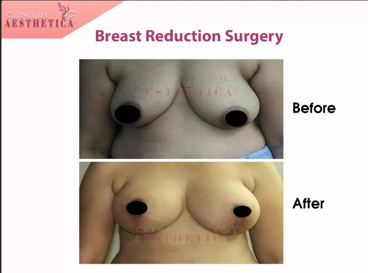 breast reduction surgery results