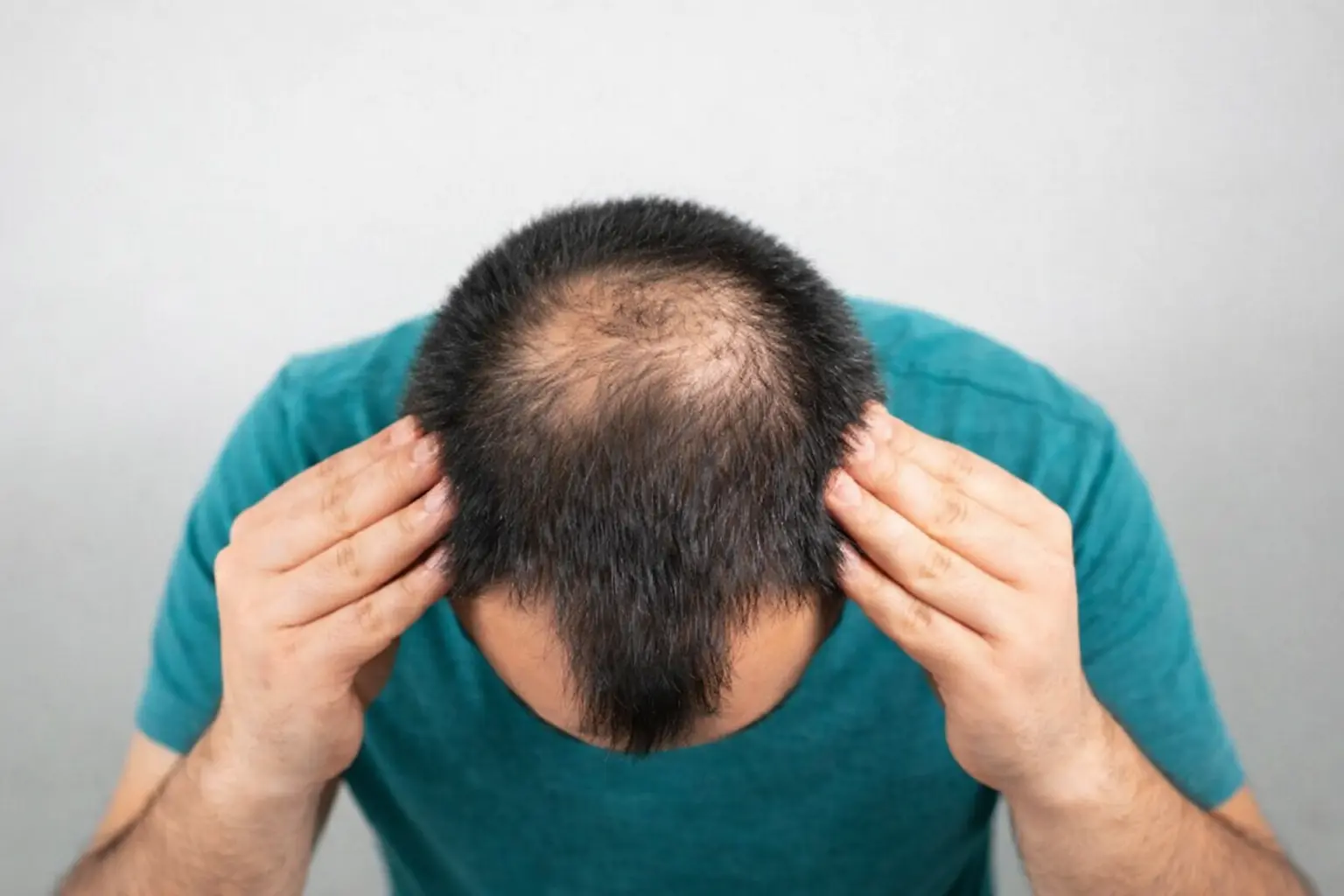 baldness-stage-look like this