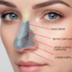 Rhinoplasty Surgery