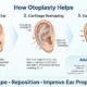 How otoplasty helps with prominent ear correction and cartilage reshaping